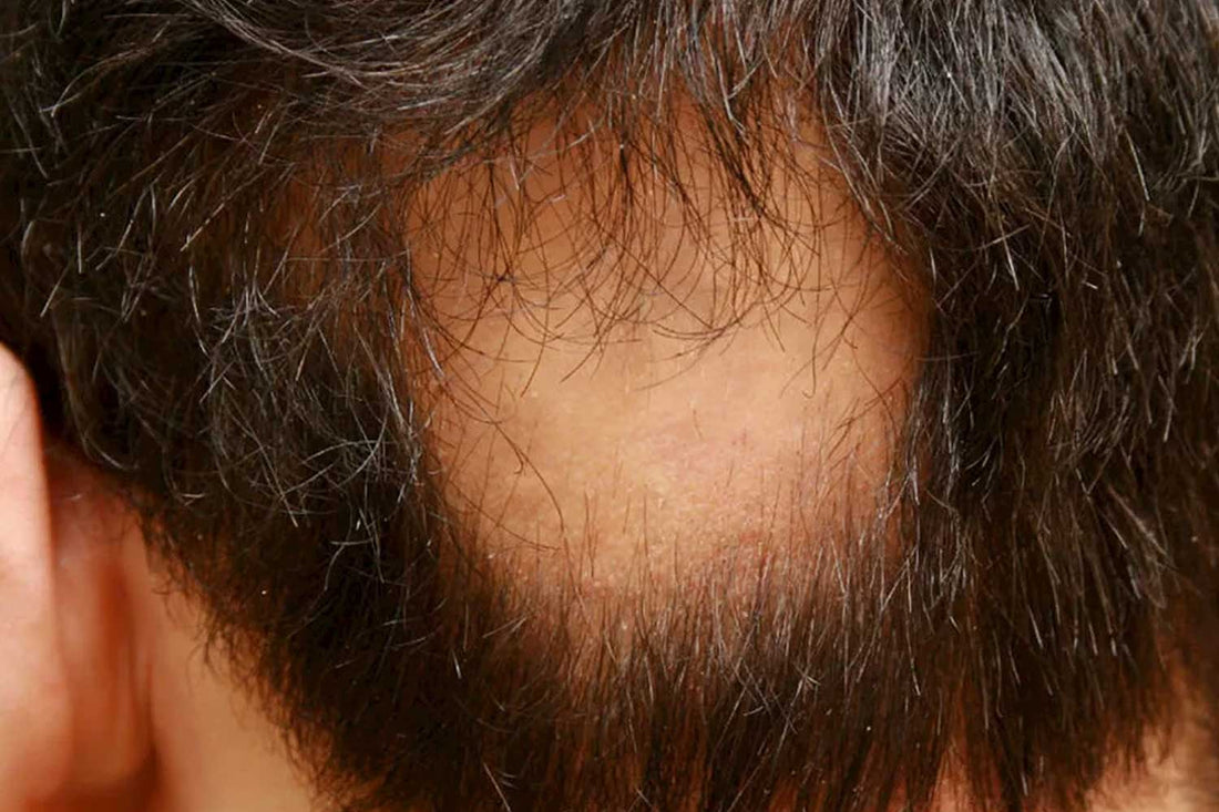 Alopecia Areata: What Is It and How Do You Recognise It?