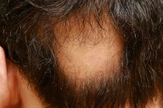Alopecia Areata: What Is It and How Do You Recognise It?