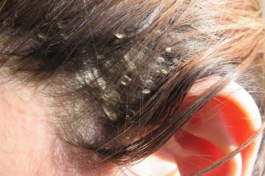Dandruff: What is It? And How to Get Rid of Dundruff