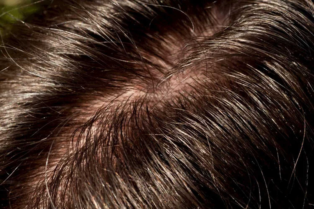 Do You Suffer From Oily Hair or an Oily Scalp? Our Advice.