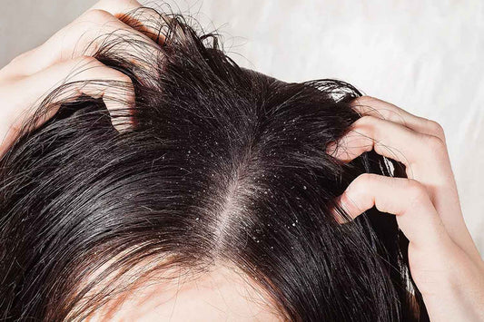 Dry Scalp: How To Get Rid Of It