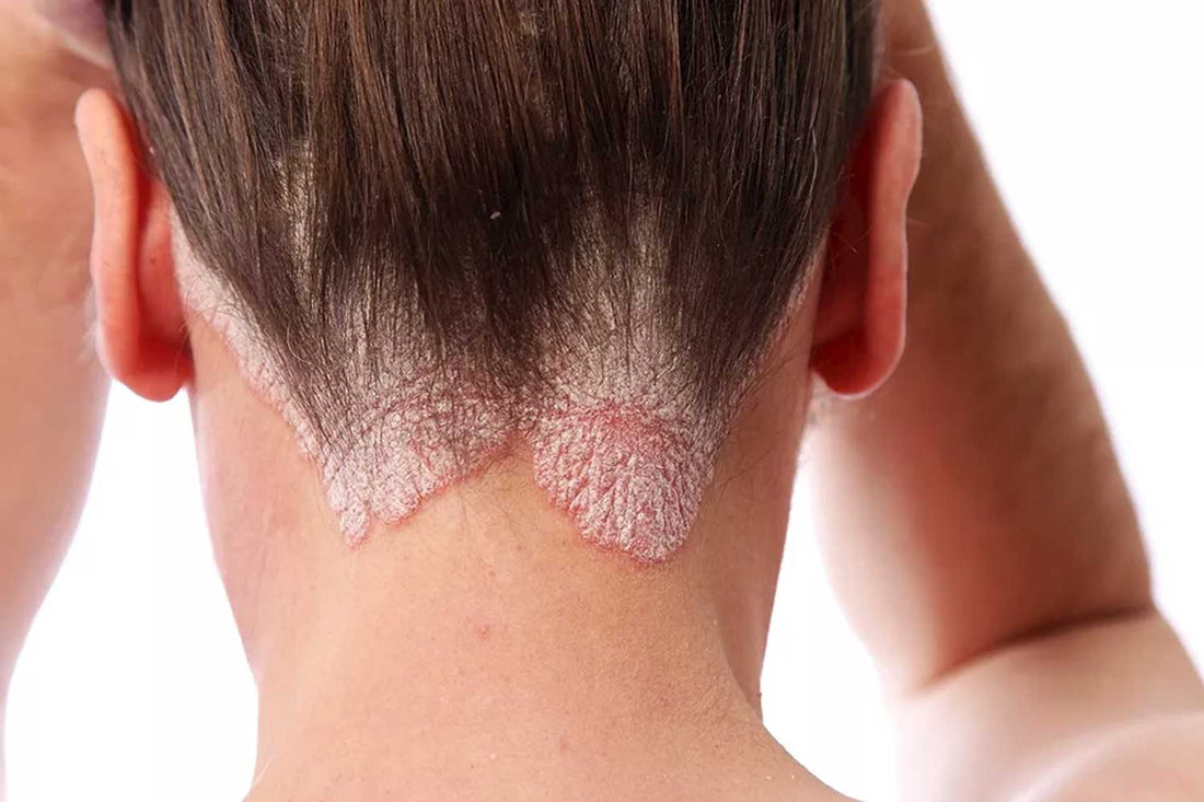 Psoriasis: What Is It And What Can You Do About It